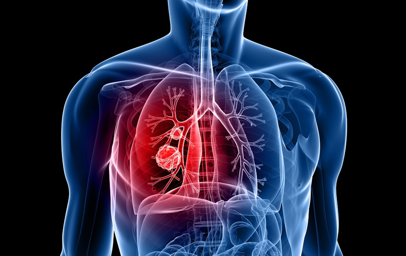 Lung cancer study day